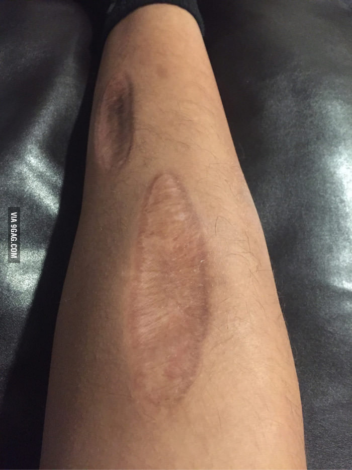 Here is my scar