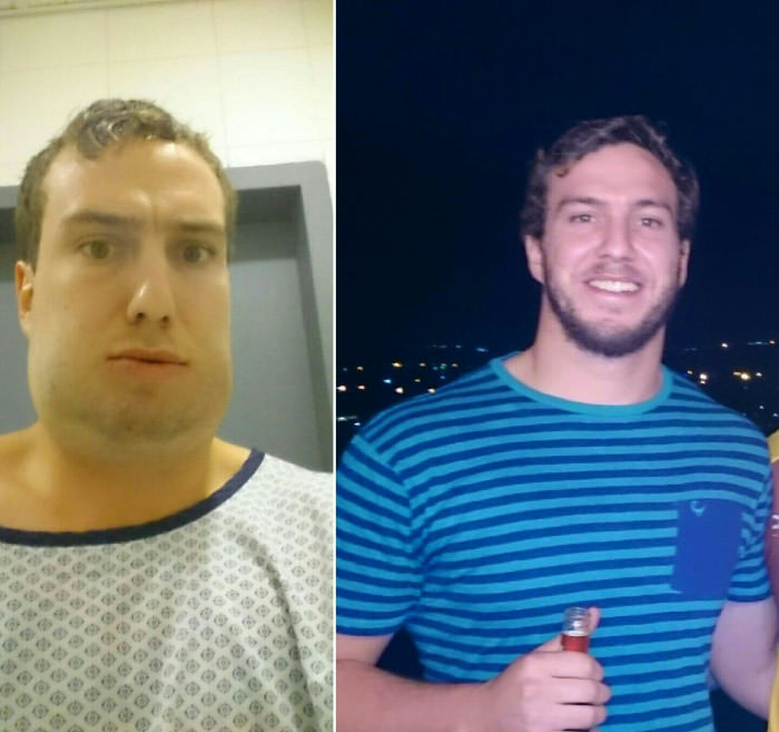 Lost 20kg through hard dieting and exercise... just kidding broke my jaw