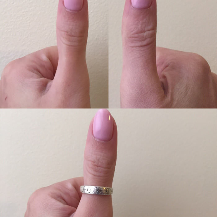 My thumb is deformed from wearing the same ring everyday for 13 years