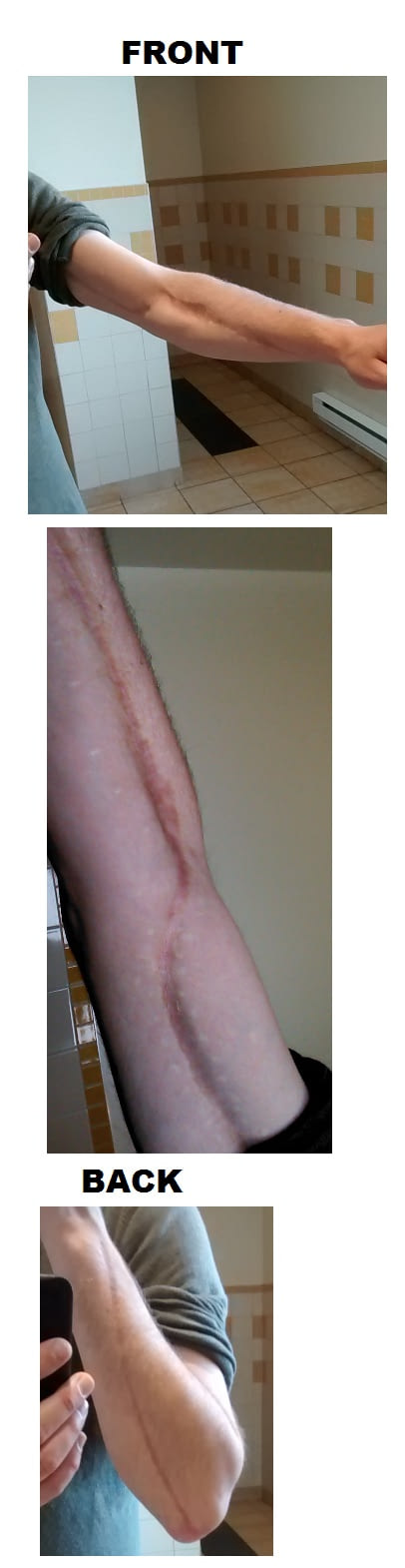 I had the flesh eating bacteria 5 years ago. Here are pictures of the scar, as requested.